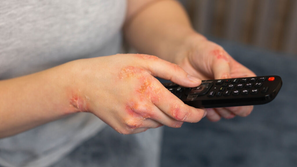 psoriasis aan handen