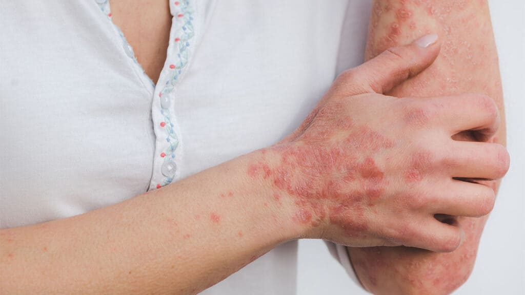 psoriasis